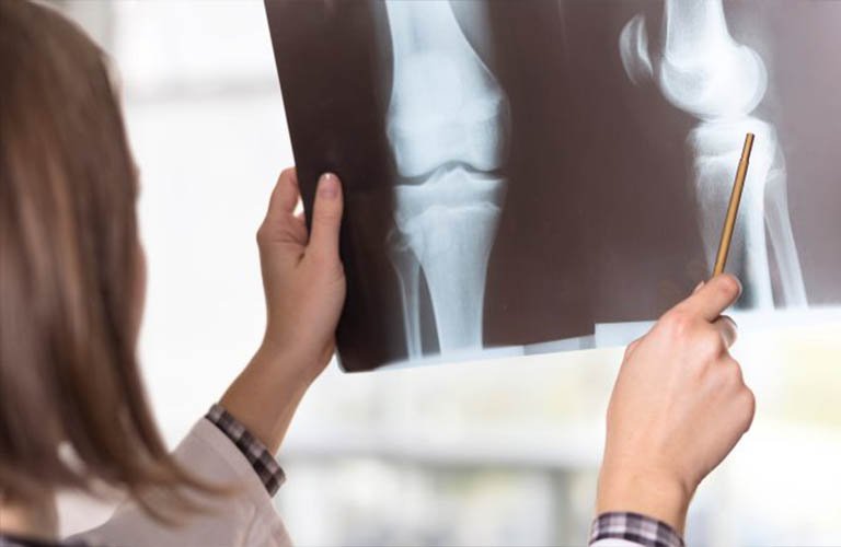 tiêu chuẩn chẩn đoán viêm khớp dạng thấp dựa trên chụp xquang